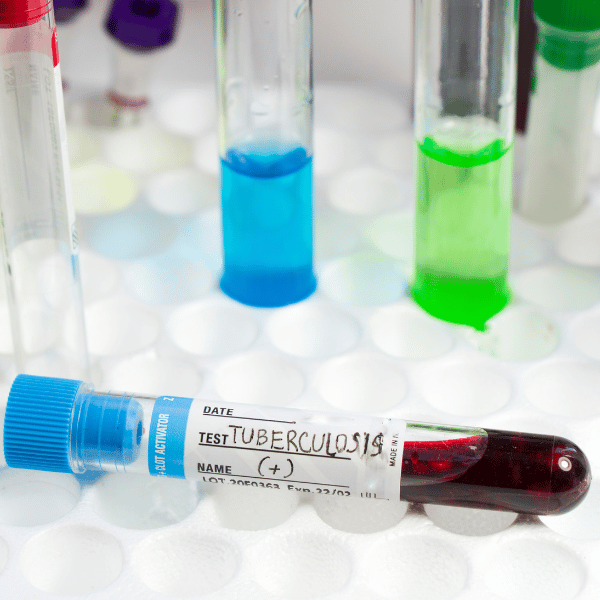 Tuberculosis testing options when labs are behind